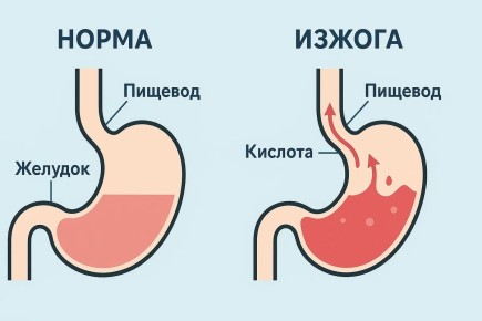 Четыре решения для здоровья: как избежать изжоги без строгих диет